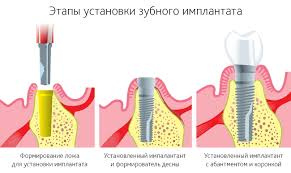Этапы установки зубного имплантата