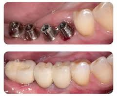 Лучшая имплантация зубов
